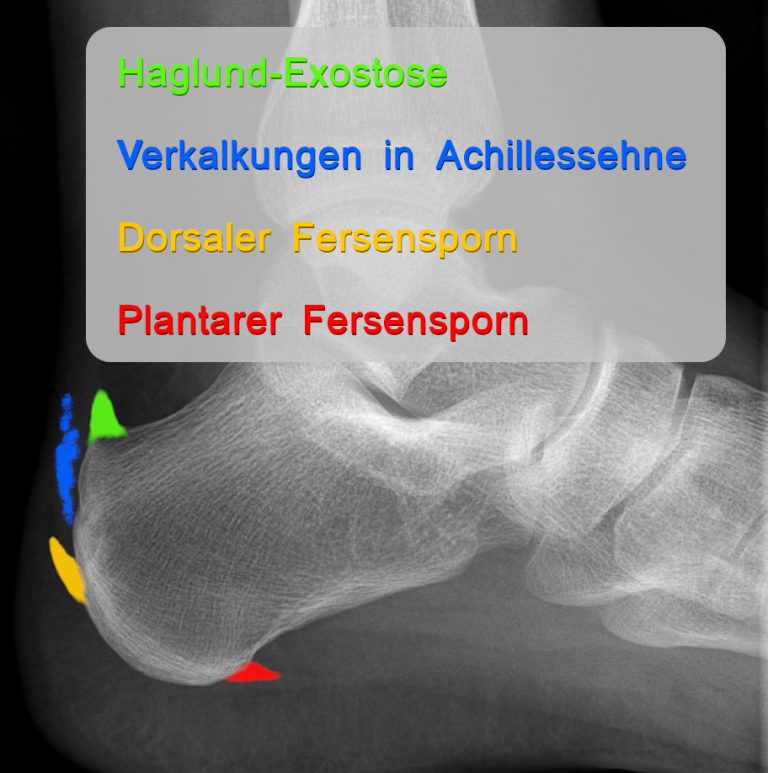 Fersensporn: Ursachen, Symptome & was jetzt hilft. Direkt, freundlich & effektiv erklärt – Dein kompletter Ratgeber gegen Fersenschmerzen!
