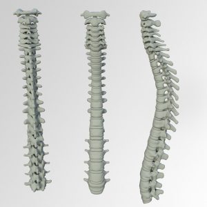 Sport bei Bandscheibenprotrusion HWS und LWS